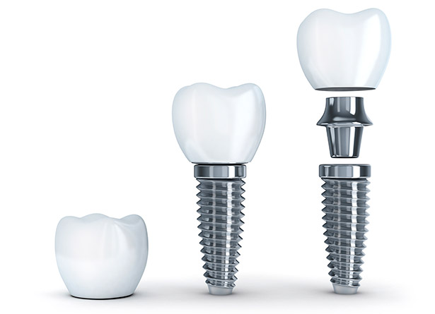 implantes dentales chamberi madrid